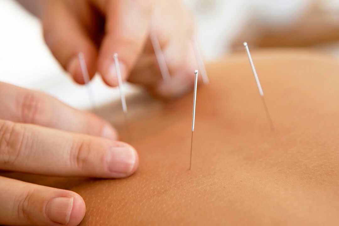 La acupuntura aumenta la efectividad